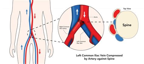 sideline iliac compression test|iliac artery pressing on vein.